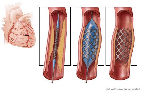 απεικόνιση stent